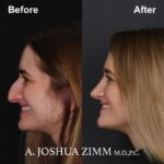 Rhinoplasty - before and after