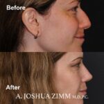 Rhinoplasty - before and after