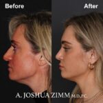 Rhinoplasty - before and after