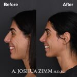 Rhinoplasty - before and after