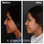 Rhinoplasty - before and after