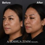 Rhinoplasty - before and after