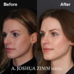 Rhinoplasty - before and after