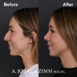 Rhinoplasty - before and after