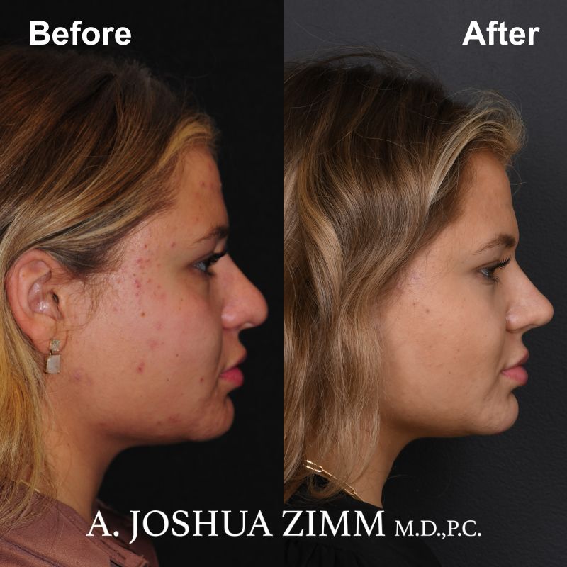 Rhinoplasty - before and after