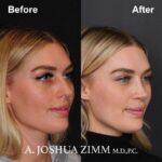 Rhinoplasty - before and after