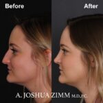 Rhinoplasty - before and after