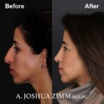 Rhinoplasty - before and after