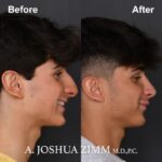 Rhinoplasty - before and after