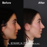 Rhinoplasty - before and after