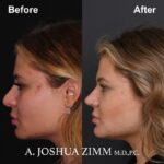 Rhinoplasty - before and after