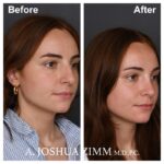 Rhinoplasty - before and after