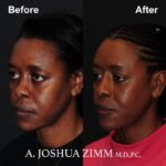 Rhinoplasty - before and after