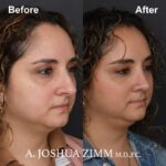 Rhinoplasty - before and after