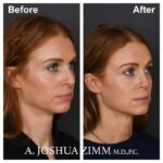 Rhinoplasty - before and after