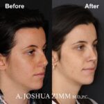 Rhinoplasty - before and after