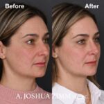 Rhinoplasty - before and after