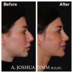 Rhinoplasty - before and after