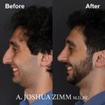 Rhinoplasty - before and after