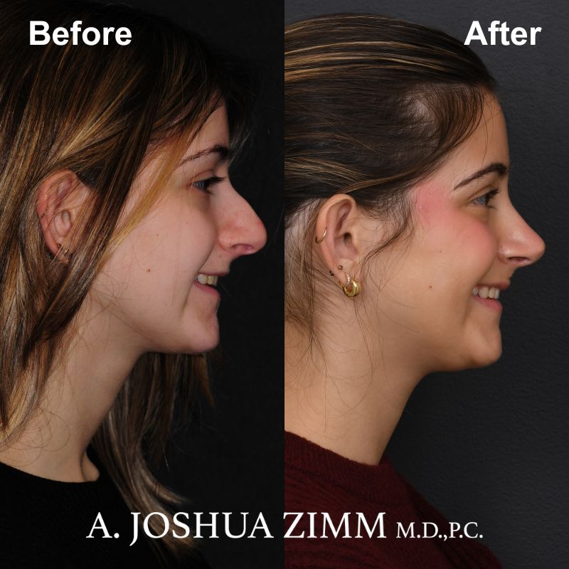 Rhinoplasty - before and after