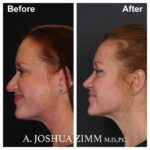 Rhinoplasty - before and after