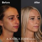 Rhinoplasty - before and after