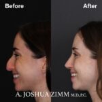 Rhinoplasty - before and after