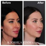 Rhinoplasty - before and after