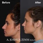 Rhinoplasty - before and after