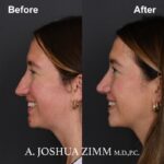 Rhinoplasty - before and after