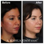 Rhinoplasty - before and after