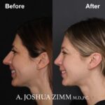 Rhinoplasty - before and after