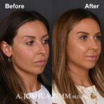 Rhinoplasty - before and after