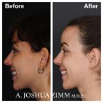 Rhinoplasty - before and after