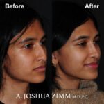 Rhinoplasty - before and after