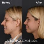 Rhinoplasty - before and after