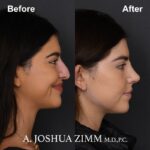 Rhinoplasty - before and after