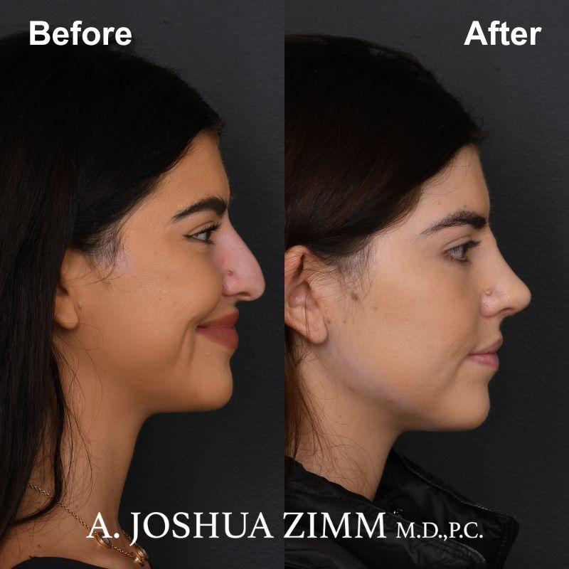 Rhinoplasty - before and after