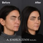 Rhinoplasty - before and after