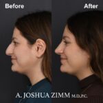 Rhinoplasty - before and after