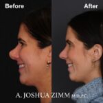 Rhinoplasty - before and after