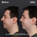 Rhinoplasty - before and after