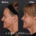 Rhinoplasty - before and after