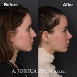 Rhinoplasty - before and after