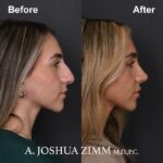 Rhinoplasty - before and after