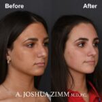 Rhinoplasty - before and after