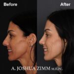 Rhinoplasty - before and after