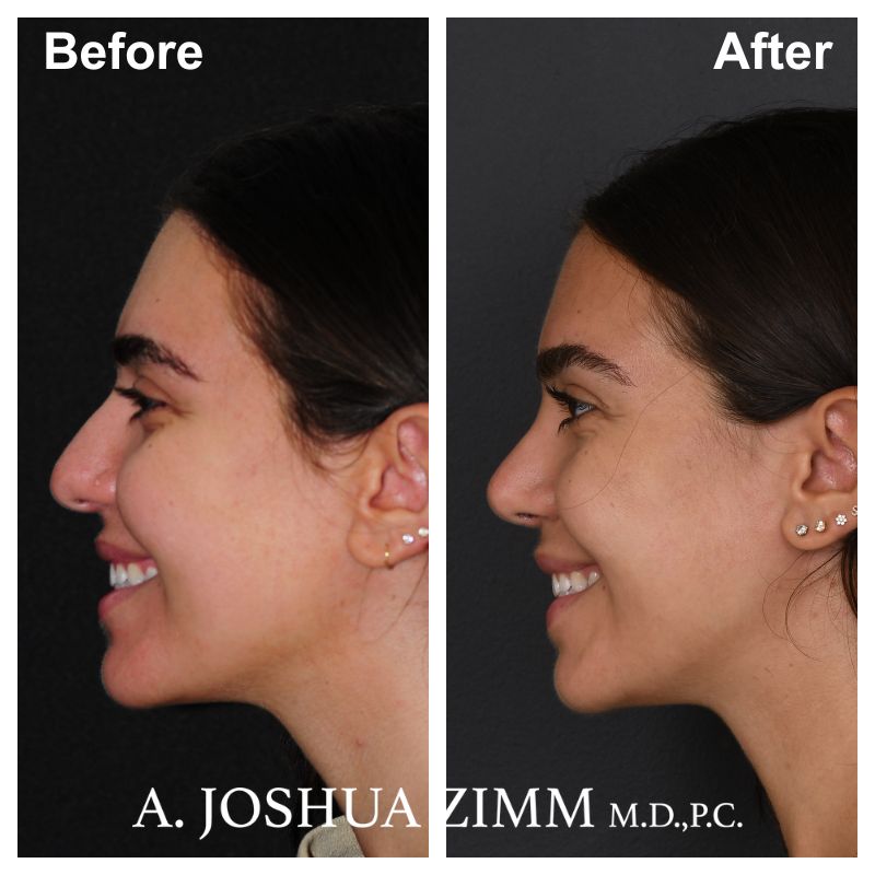 Rhinoplasty - before and after