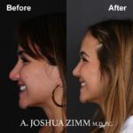 Rhinoplasty - before and after