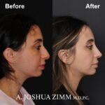 Rhinoplasty - before and after